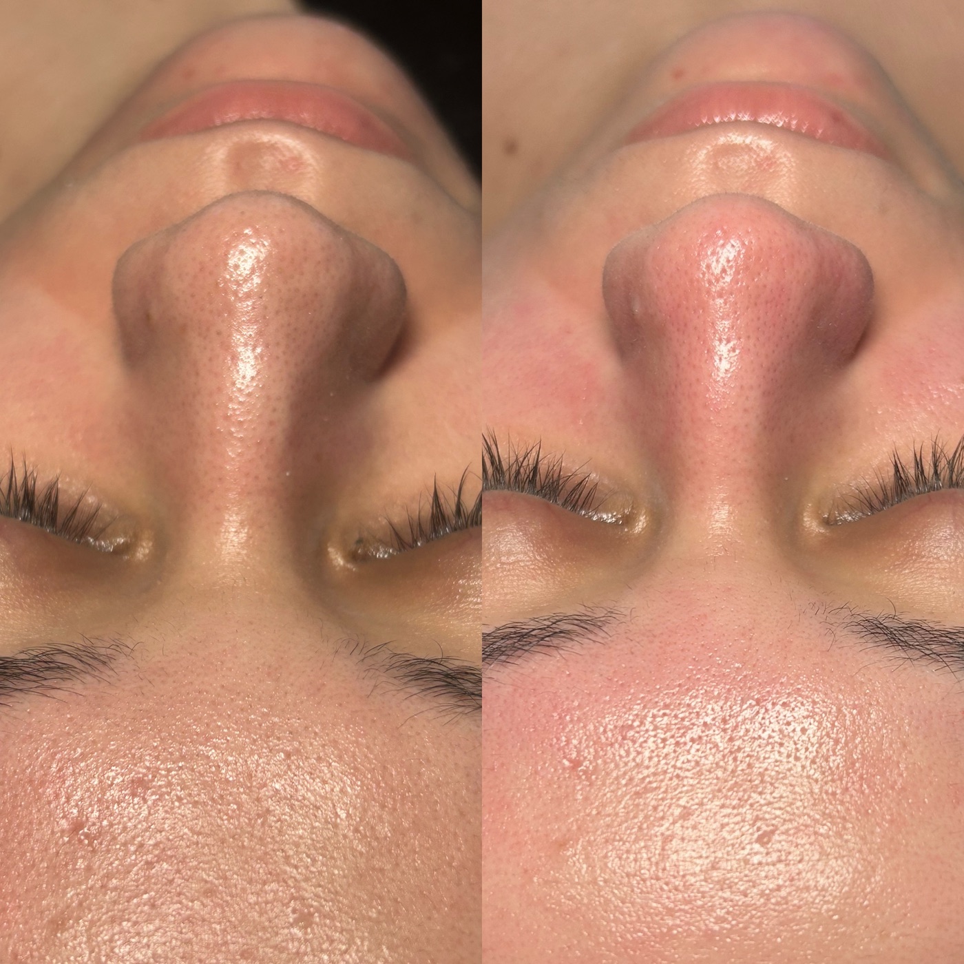 Before and after results of a customized facial at Luna Tropical Esthetics
